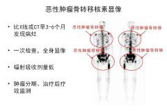 上饒市信州區惠民醫院核醫學(xué)科骨檢查與治療